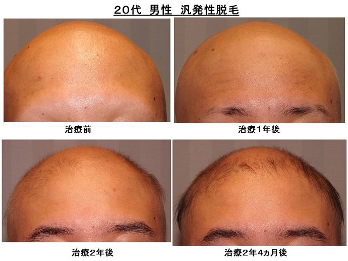 円形脱毛症　病院""